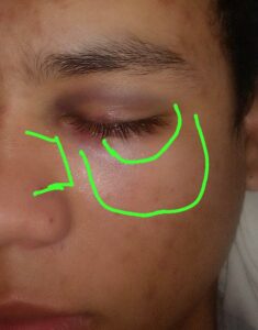 Foto: Las líneas verdes marcan las zonas del rostro donde están las fracturas