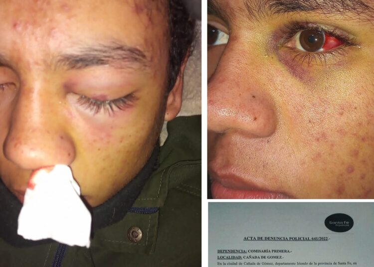 Cañada de Gómez: Un joven terminó con una triple fractura en el rostro tras ser golpeado por otro en la escuela